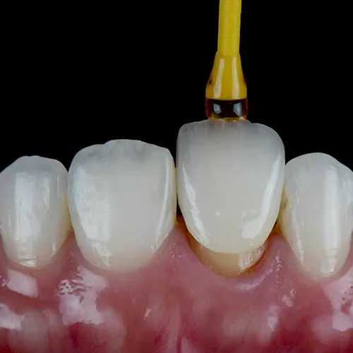 tool placing a front tooth crown