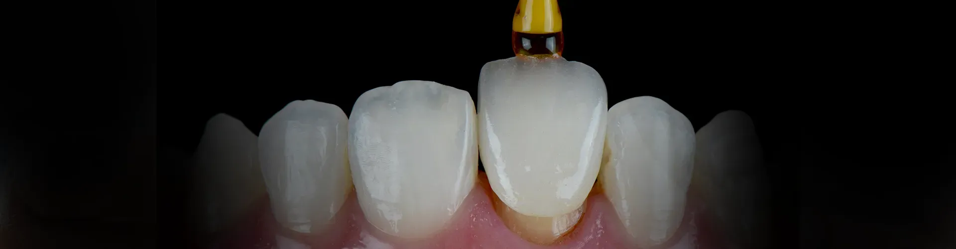 tool placing a front tooth crown