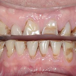 Before and after images of ruined teeth. These images show a result of the work of the dentist.