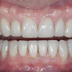 Before and after images of ruined teeth. These images show a result of the work of the dentist.